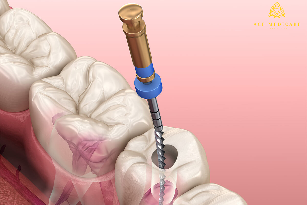 A Step-by-Step Guide to Understanding the Root Canal Procedure
